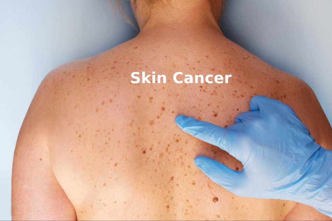 Skin Cancer: Signs, Symptoms, Types and More
