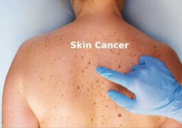 Skin Cancer: Signs, Symptoms, Types and More