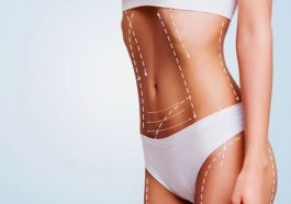 What Is a Liposuction Procedure?